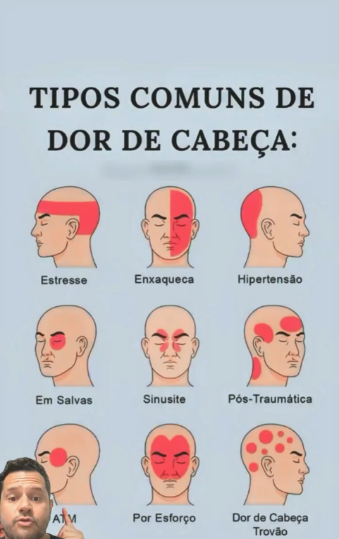 ilustração mostrando os diferentes tipos de dor de cabeça e suas localizações na cabeça